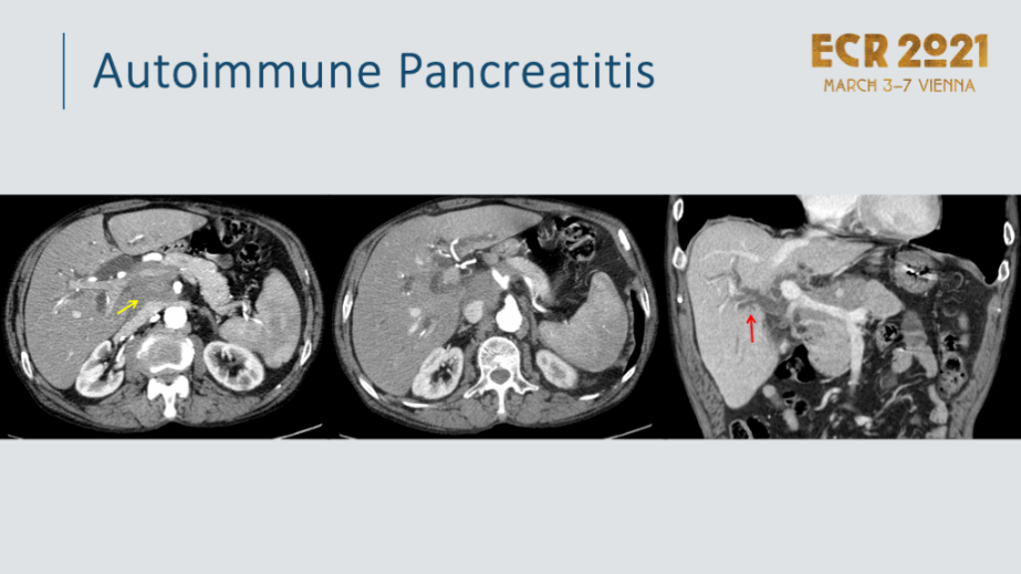 Pancréatite auto-immune (AIP)