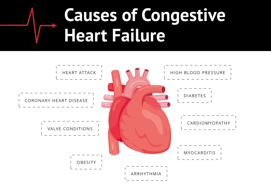 Causes de l'insuffisance cardiaque congestive