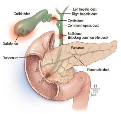 Gallbladder inflammation (cholecystitis)