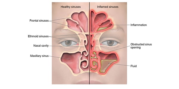 Sinus infection