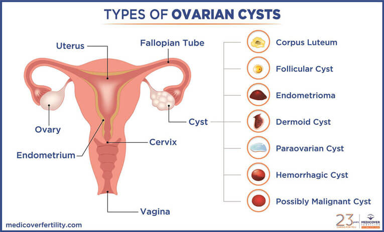 Arten von Ovarialzysten