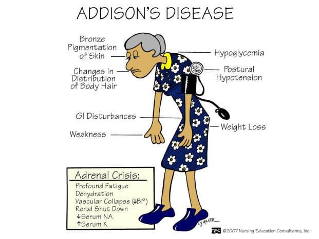 Was ist die Addison-Krankheit