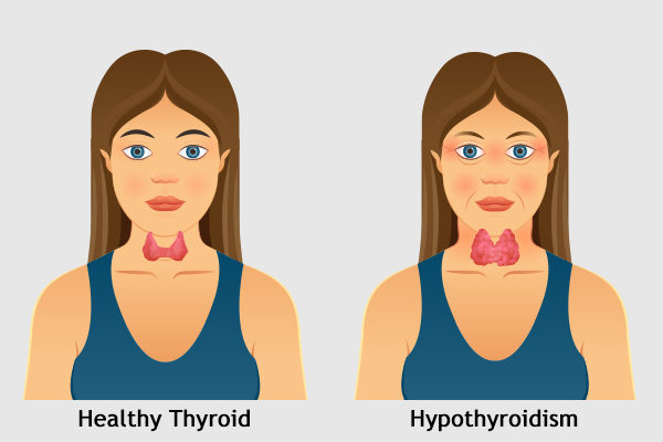healthy vs Hypothyroidism