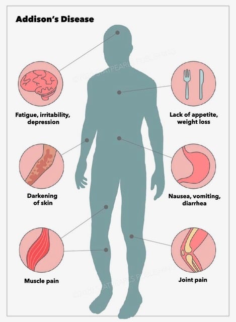 symptoms of Addison’s disease