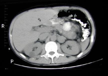 Abdominal computed tomography (CT) 