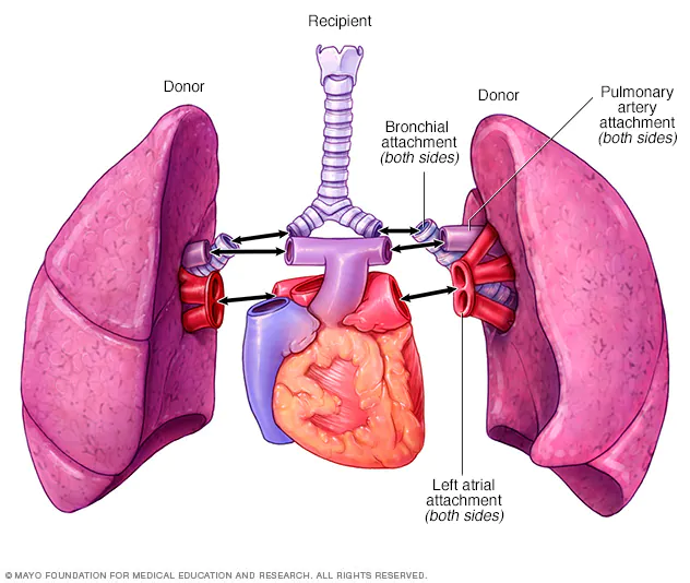 Double Lung Transplant