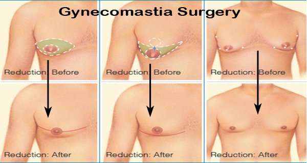 Gynecomastia Surgery (Gynäkomastie-Chirurgie)
