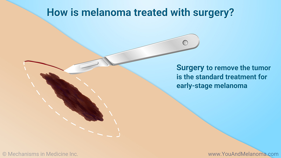 Melanoma treatment surgery