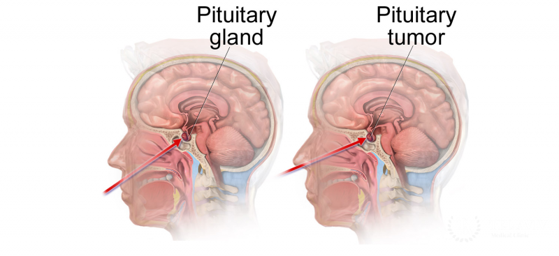Pituitary Tumor
