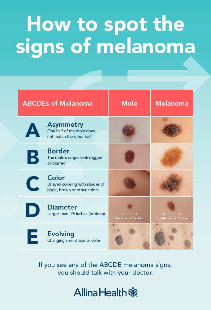 Signs of Melanoma