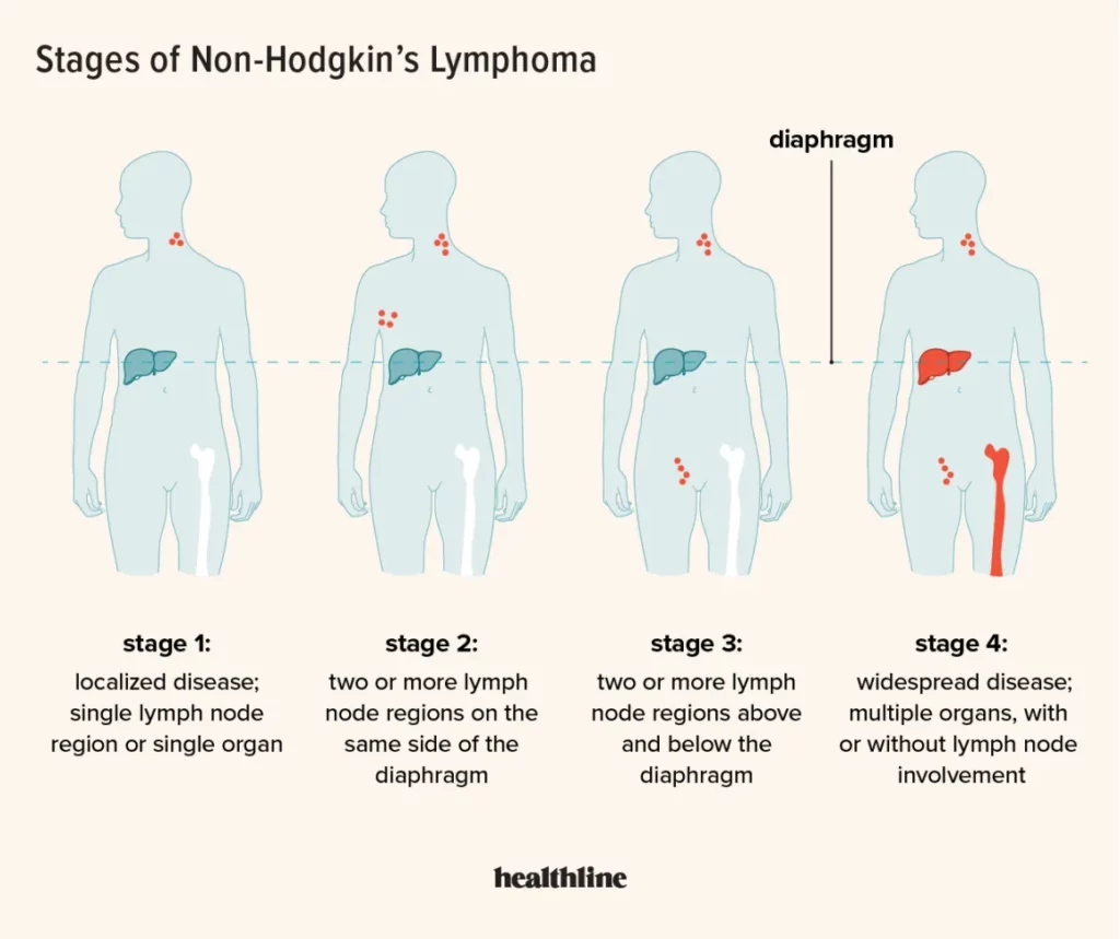 مراحل سرطان الغدد الليمفاوية