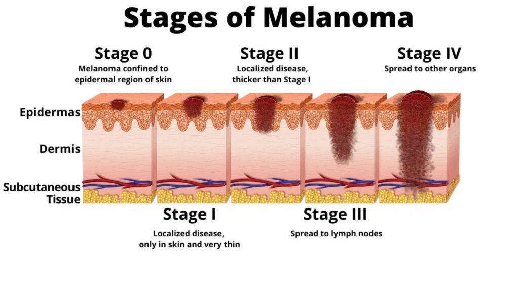 Stages of Melanoma