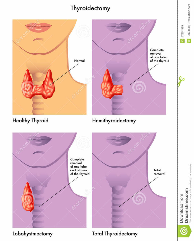 Thyroidectomy - thyroid nodule treatment
