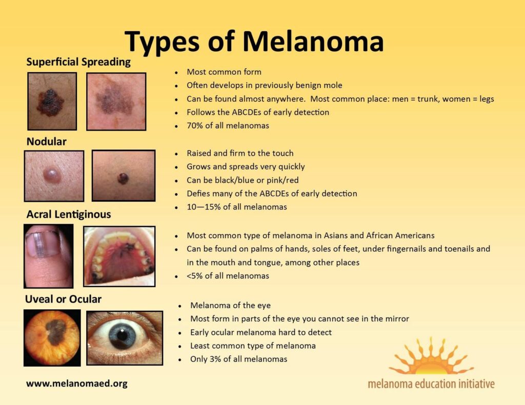 Types of Melanoma