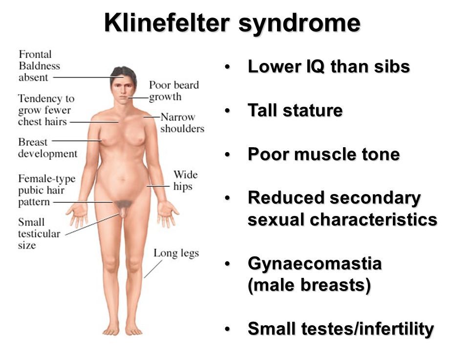 symptoms of Klinefelter syndrome 