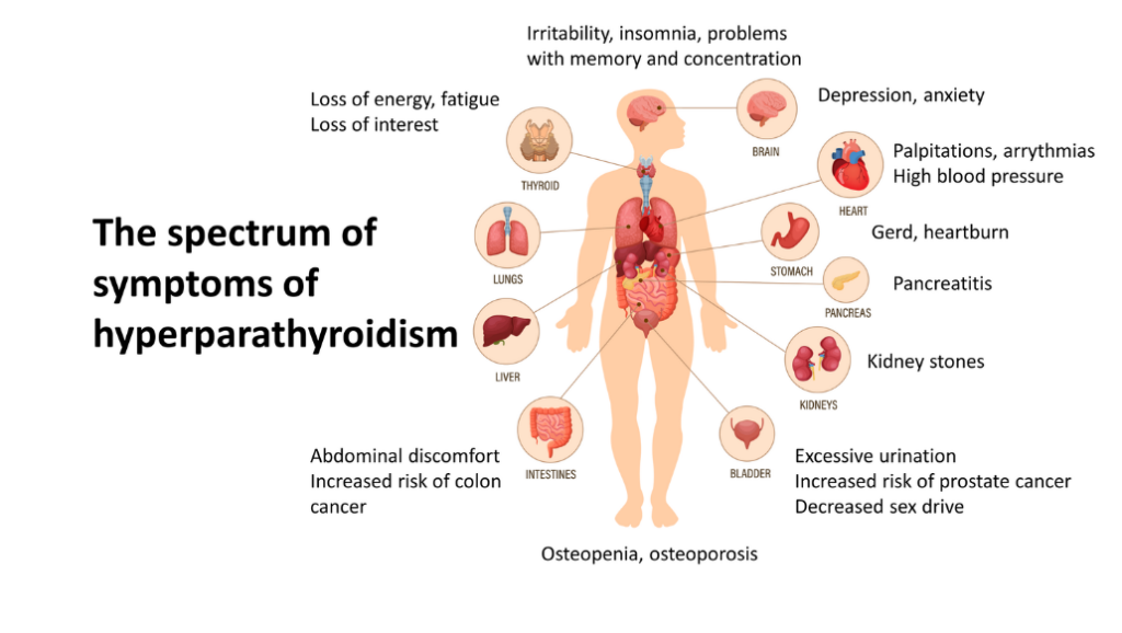 symptoms of hyperparathyroidism