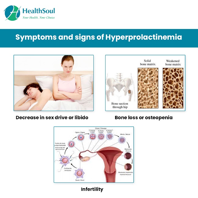 symptômes de l'hyperprolactinémie