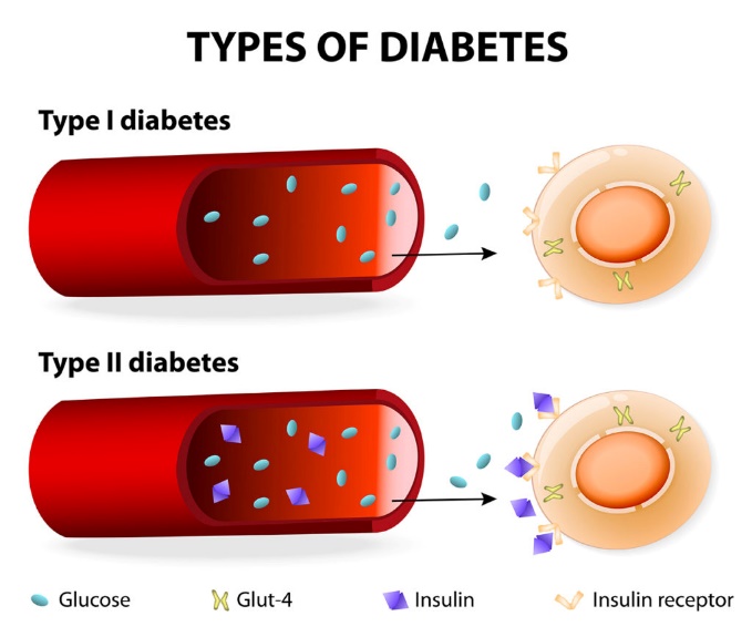 types of diabetes mellitus