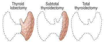 types of thyroidectomies