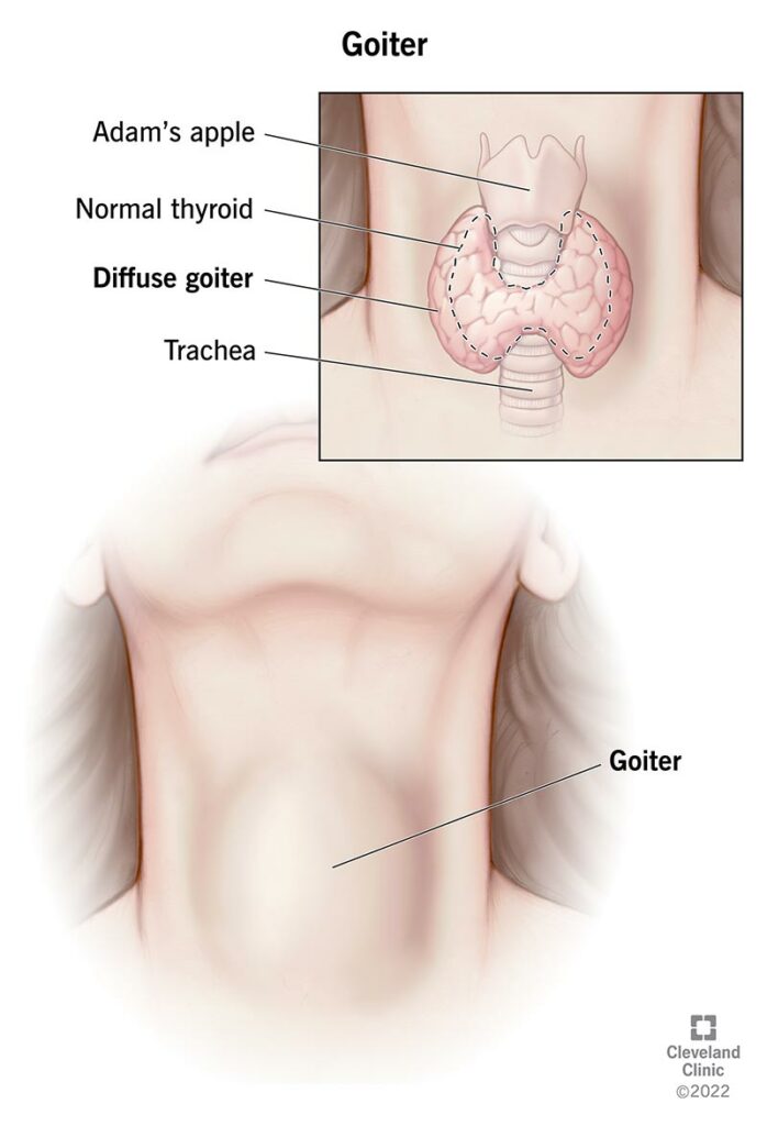 what is a goiter