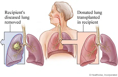 Qu'est-ce qu'une double transplantation pulmonaire