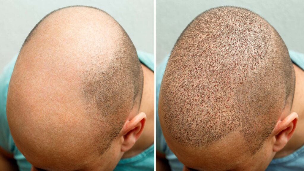 What is a hair transplant