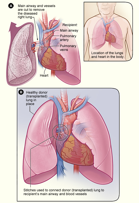 What is the preparation for a double lung transplant surgery