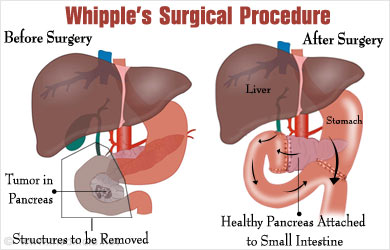 Whipple’s surgery