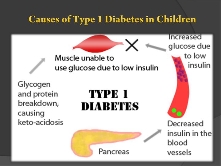 causes of type 1 diabetes in children
