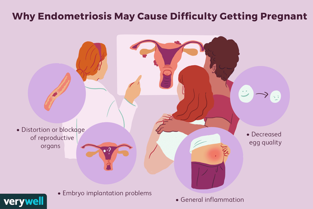 concebir con endometriosis