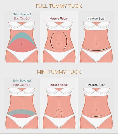types of tummy tuck