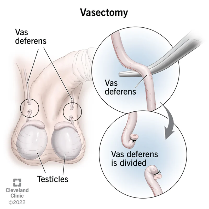 vasectomy procedure