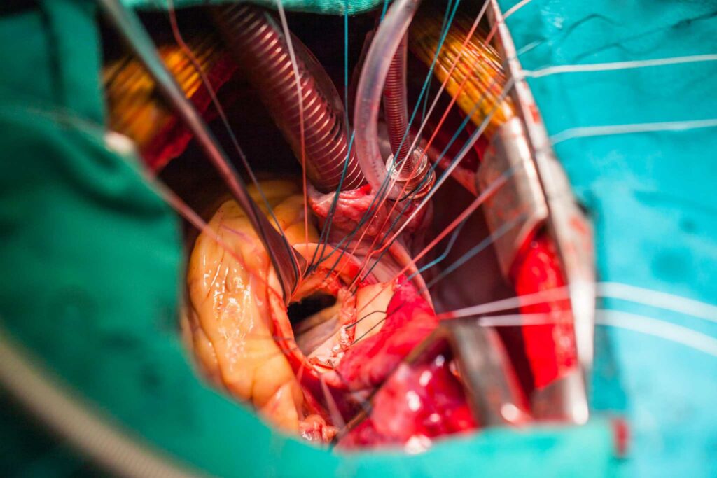 Was ist eine Herzklappenersatzoperation?
