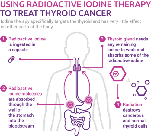 How does radioactive iodine treat thyroid cancer