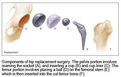 Partes de un implante de reemplazo de prótesis de cadera