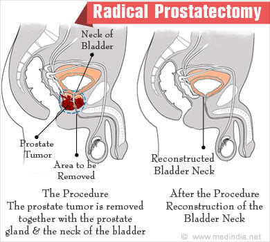 Prostatectomie radicale