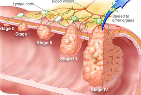Stages of Colon Cancer  