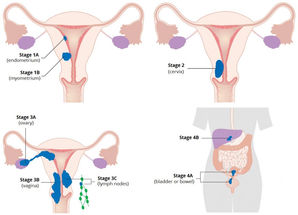 What is endometrial cancer staging?