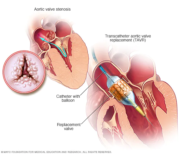 Transkatheter-Aortenklappenersatz