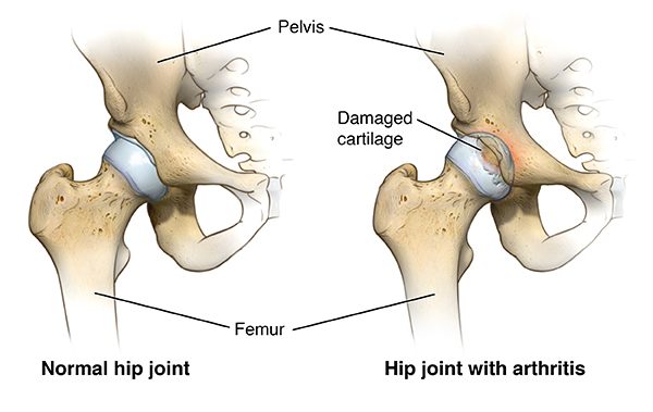 Types de procédures de remplacement de la hanche