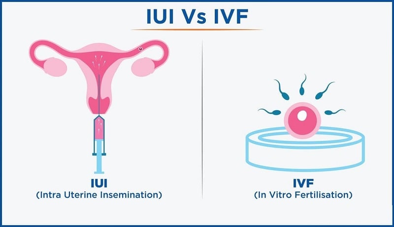 Was ist IUI vs. IVF?