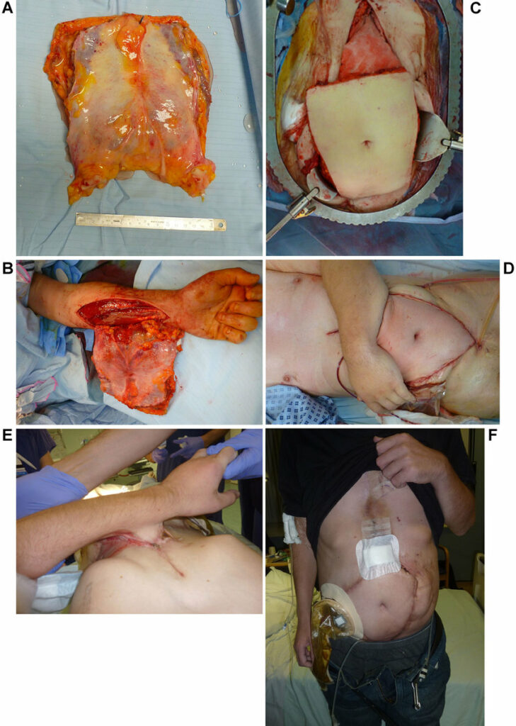 abdominal wall transplant procedure