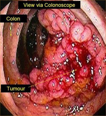 adenocarcinoma of the sigmoid colon diagnosis