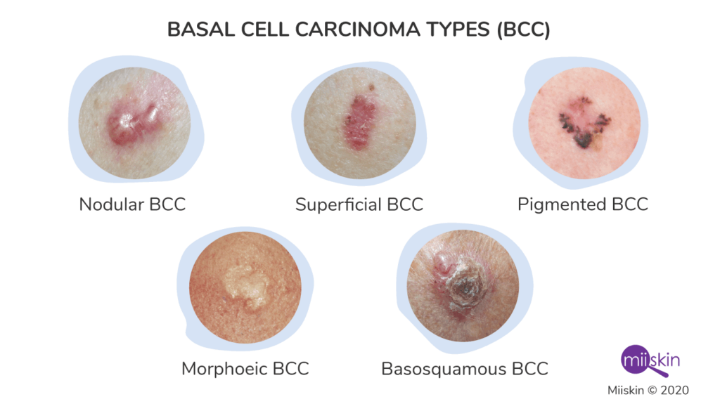 basal cell carcinoma types