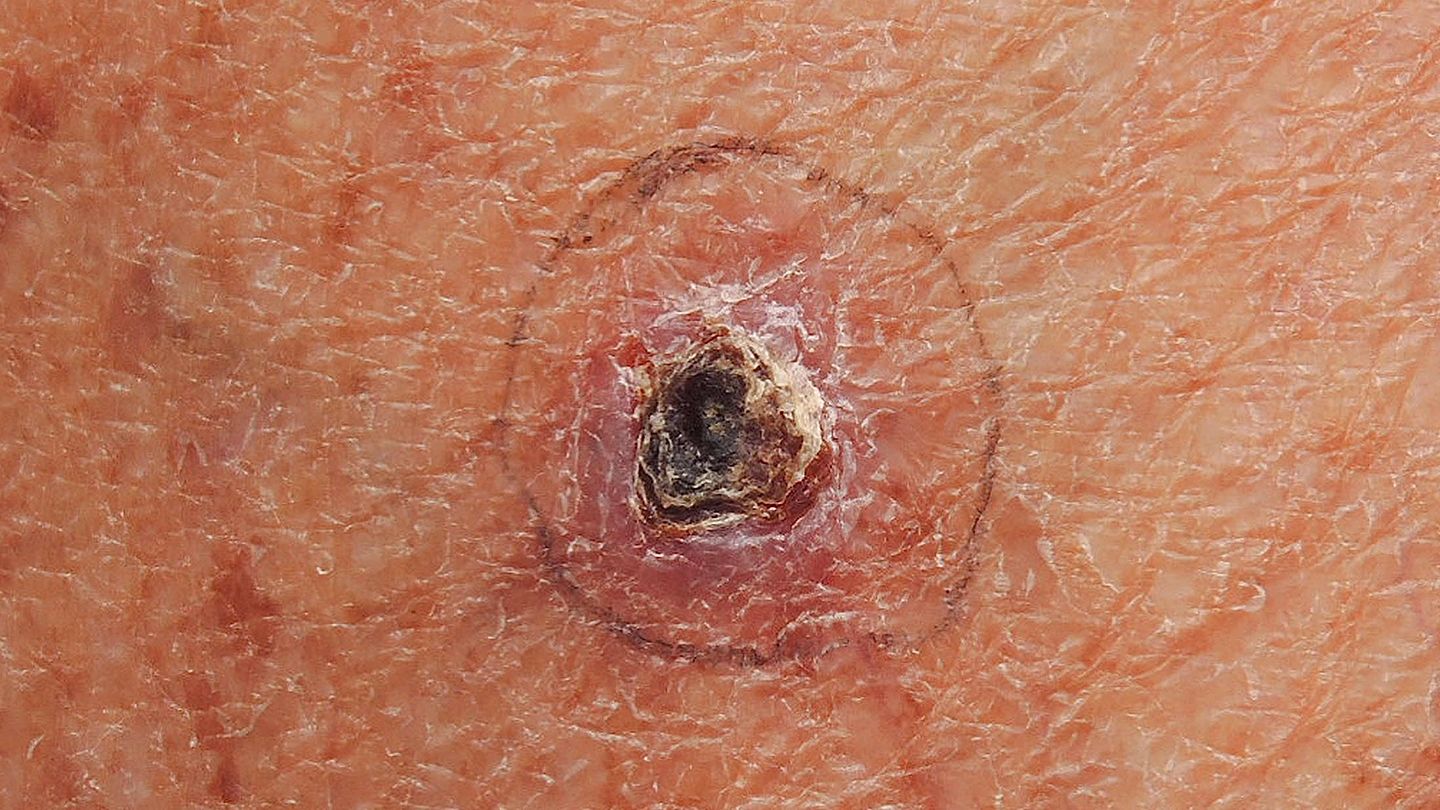 Basal Cell Carcinoma (BCC on the Face)