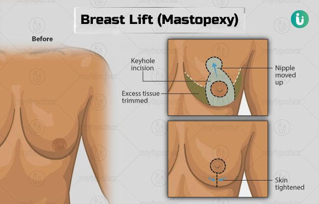 breast lift mastopexy procedure
