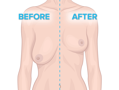 Who needs breast uplift surgery
