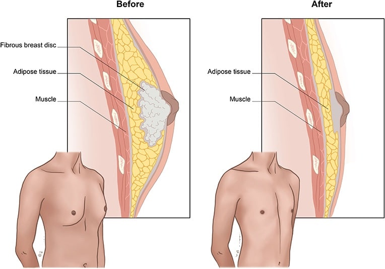 cirugía de reducción mamaria- ginecomastia