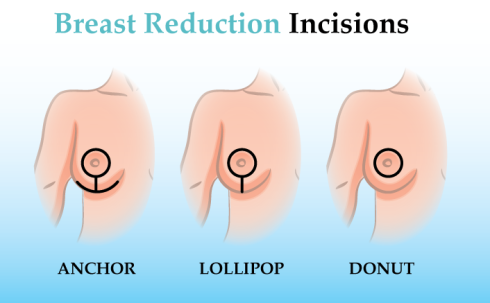 procedimiento de cirugia de reduccion de senos
