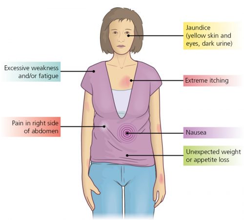Symptome eines Cholangiokarzinoms